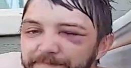 Man with a bruised eye relaxing in a hot tub, showcasing the quirky and unpredictable side of Loulz IP2 culture.