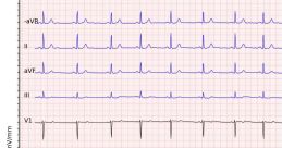 ECG ECG - ECG or Electrocardiography and effect requested by sumith. The first that comes to mind when thinking about