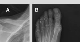 X-ray images showing skeletal deformities associated with Rickets, highlighting changes in the shoulder and foot bones.