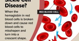 Sickle cell disease explained: abnormal red blood cells turn crescent-shaped, blocking blood flow and causing health issues.