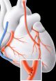 Diagram of the heart highlighting bypass surgery with sutured arteries, illustrating blood flow and surgical site details.