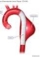 Aneurysm The word "Aneurysm" itself ominous and heavy, with its hard consonants and drawn-out vowels. It conveys a sense of