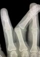 X-ray of a hand showing detailed bone structure, highlighting finger joints and potential fractures for medical analysis.