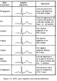 EKG wave components including P, Q, R, S, and T waves with detailed definitions and graphical depictions for analysis.