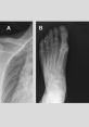 X-ray images showing skeletal deformities associated with Rickets, highlighting changes in the shoulder and foot bones.